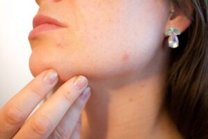 Empresa terá que indenizar cliente do RS que teve alergia a cosmético