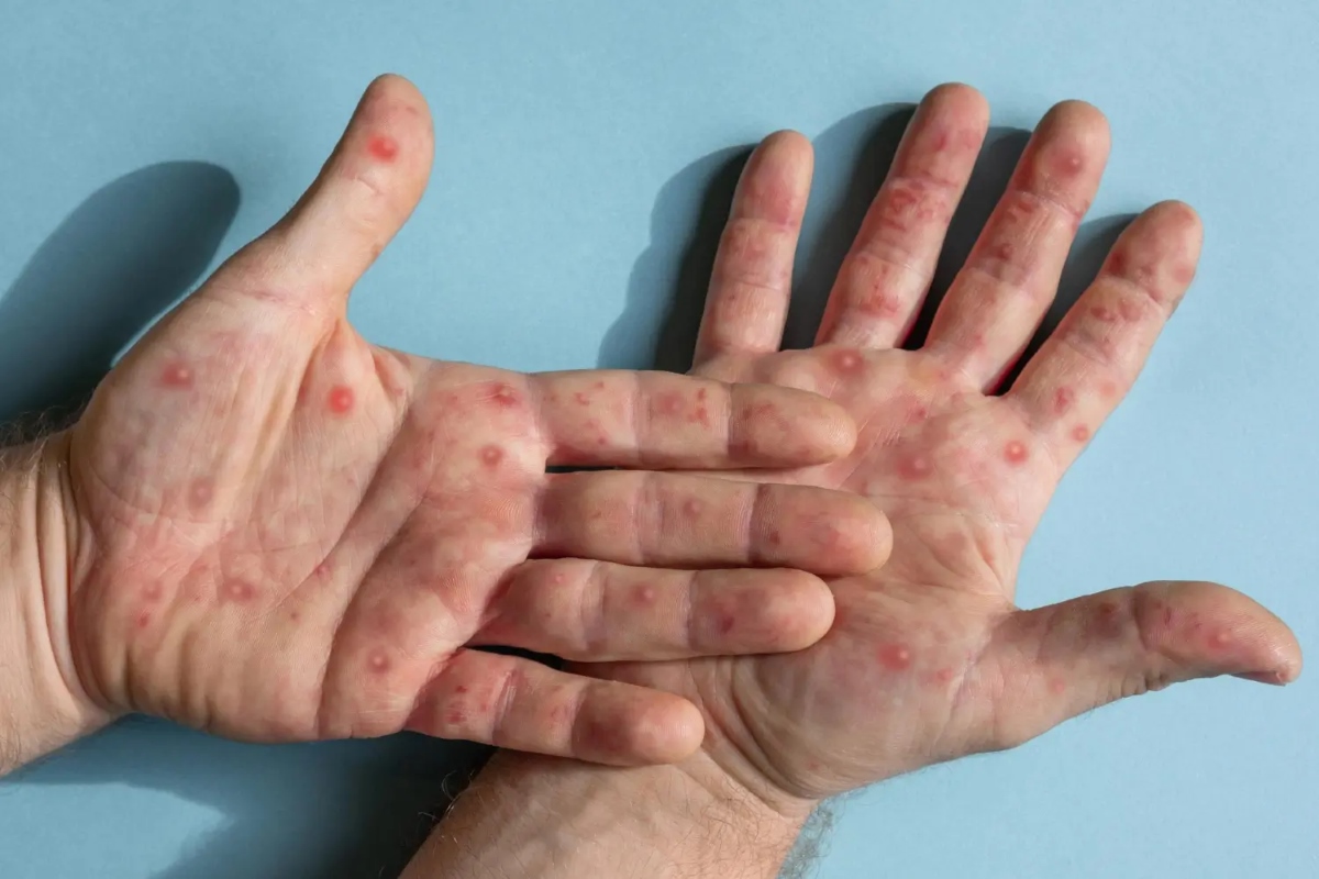 Estado de SP registra 315 casos de mpox nos primeiros 7 meses de 2024 Estado de SP registra 315 casos de mpox nos primeiros 7 meses de 2024