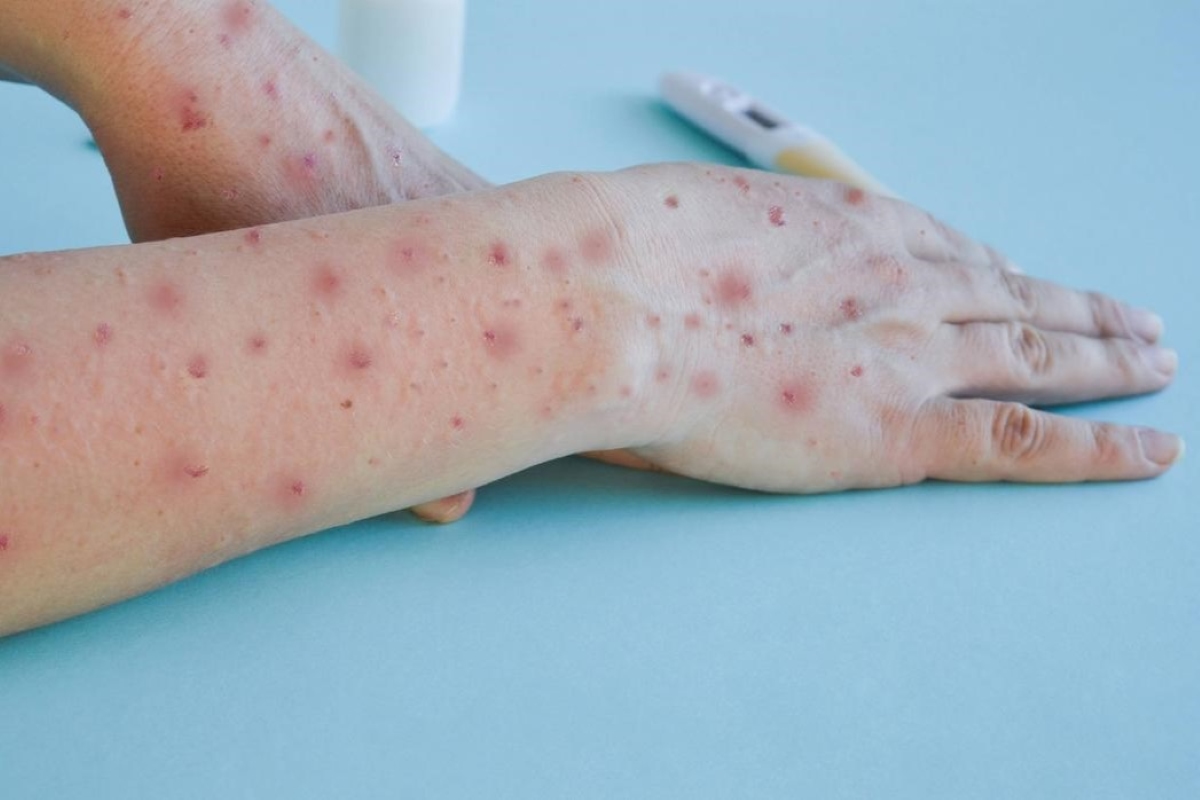 Veja quais são as 5 cidades paulistas com mais casos de mpox neste ano