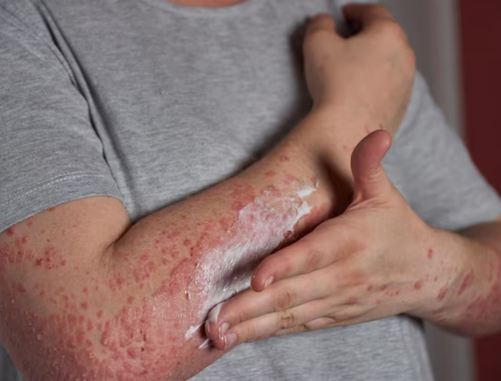 Saiba o que é a psoríase e como prevenir e tratar